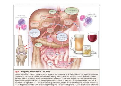 Alcohol Use in Patients with Chronic Liver Disease